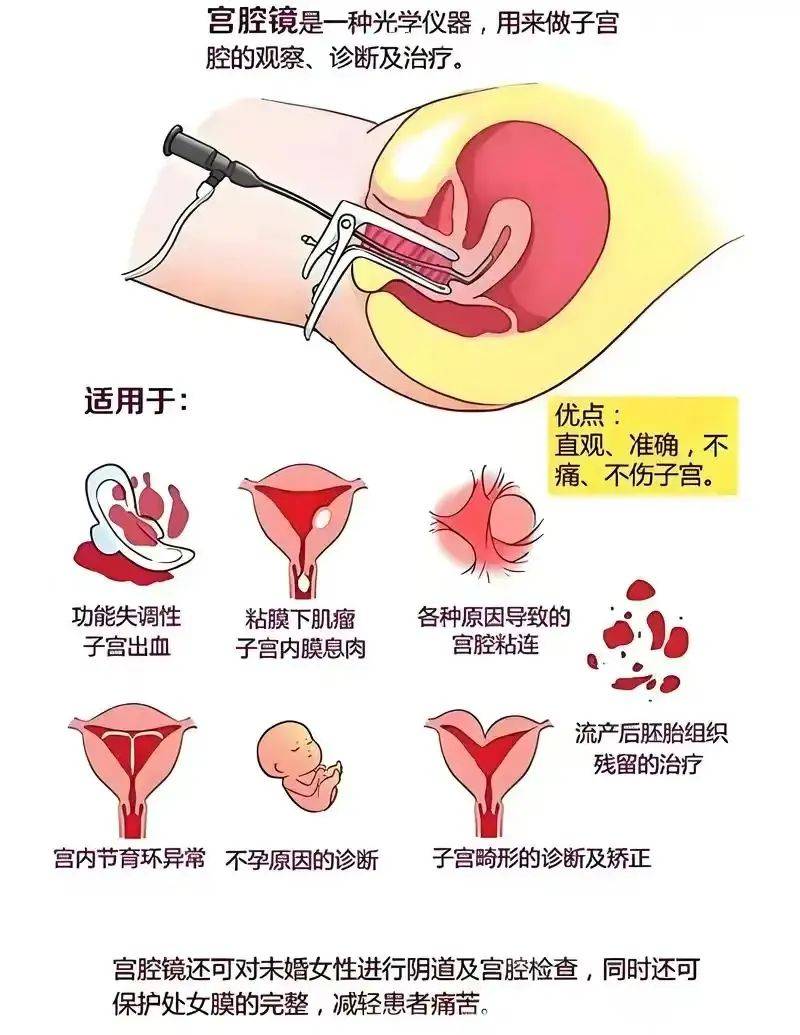 宫腔镜手术